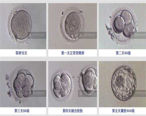 漳州哪有捐卵，早期卵巢癌5年后复发率多高