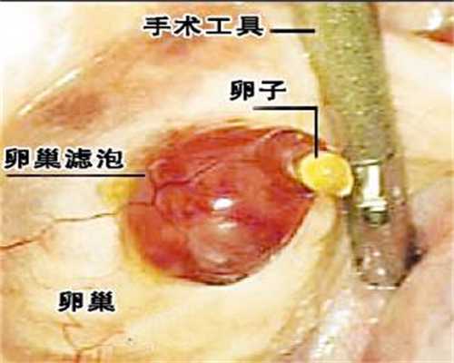 重庆中国女生捐卵，如何确诊是多囊卵巢